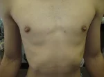 乳頭縮小（男性）の術前