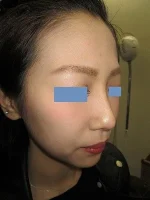 隆鼻術（ヒアルロン酸）の施注直後