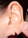 裂け耳（ピアス後の耳垂裂）