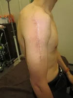 タトゥー（刺青）除去の術後