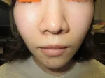 鼻翼縮小の術前