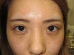 二重瞼（埋没法）の術後