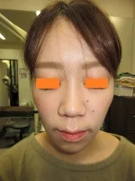 鼻翼縮小の術前