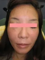 頬をふっくらさせるの治療後