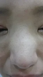 隆鼻術のヒアルロン酸注入前