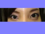 下眼瞼下制術の術後