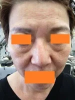 目の下のタルミ取り（ハムラ法）の術前