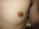 術前。左乳頭。