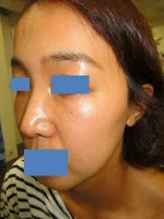 隆鼻術（ヒアルロン酸）の施注前
