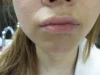 口唇のシミ（ラビアルメラノーシス）の治療後