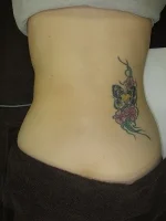 タトゥー（刺青）除去の術前