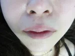口唇のヒアルロン酸の注入後