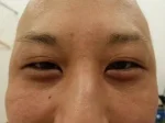 二重瞼の施術前