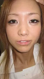 口唇のヒアルロン酸の注入後