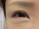 二重瞼（全切開法）の術後