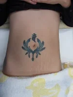 タトゥー（刺青）切除の術前