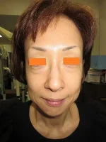 経結膜脱脂法（目の下のふくらみ取り）の術前