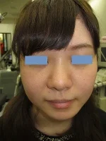 鼻翼縮小の術後