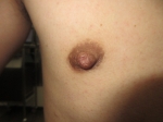 術前。右乳頭。