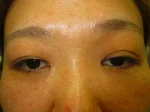 眼瞼下垂の術前