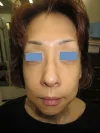 経結膜脱脂法（目の下のふくらみ取り）の術後