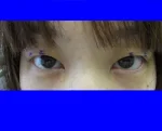 二重瞼（埋没法）の術前