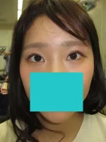 眼瞼下垂の術後