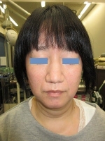 鼻尖形成術の術後