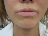 口唇のシミ（ラビアルメラノーシス）の治療前