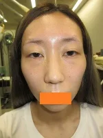 二重瞼（埋没法）の術前