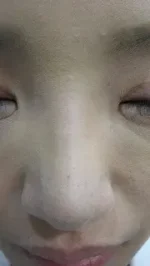 隆鼻術のヒアルロン酸注入後