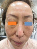 顔のイボの術前