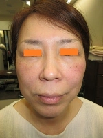 目の下のタルミ取り（ハムラ法）の術前