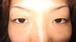 二重瞼（埋没法）の術前