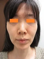 頬のタルミ治療の術前