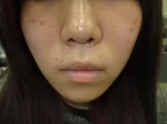 口唇拡大術の術前