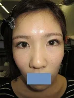 二重瞼（切開法）の術後