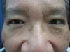 眼瞼下垂の術後