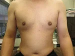 乳頭縮小（男性）（FtM）の術後