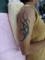 タトゥー（刺青）除去の術前