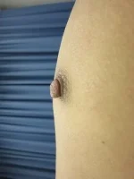 乳頭縮小（男性）の術前