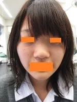 鼻尖形成術の術前