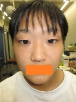 術前。正面。