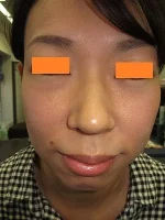 経結膜脱脂法（目の下のふくらみ取り）の術前