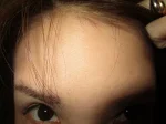 額、眉間の表情ジワの注射1週間後