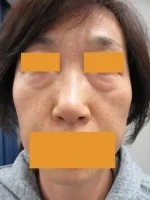 目の下のたるみ取りの術前
