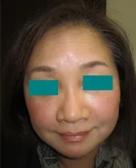 目の下タルミ取り（ハムラ法）の術後