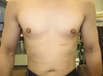 乳頭縮小（男性）の術前