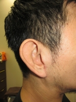 術後。右耳介。