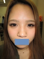 二重瞼（埋没法）の術後